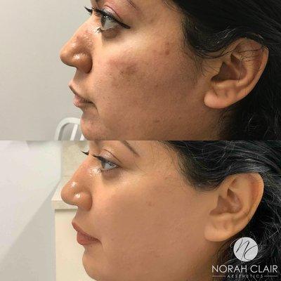 Chemical peel and medical grade skincare!