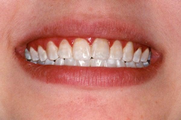 BEFORE: Discolored and misaligned teeth