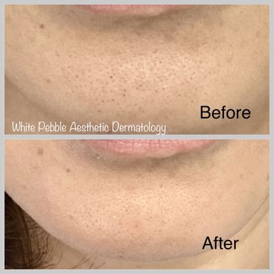 Pore decongestion immediately after 1 hydrafacial treatment.