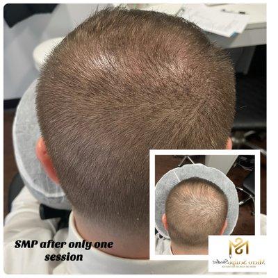 Scalp micropigmentation after 1 session