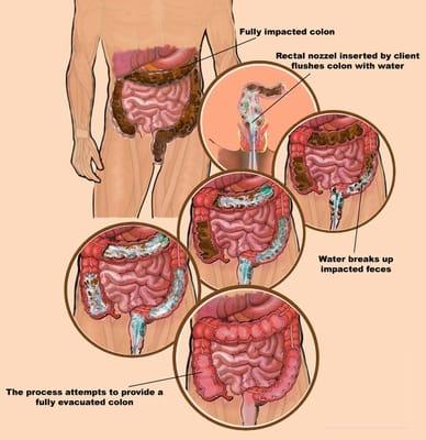 A fully impacted colon