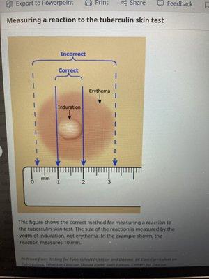 This is what induration would look like it was actually positive