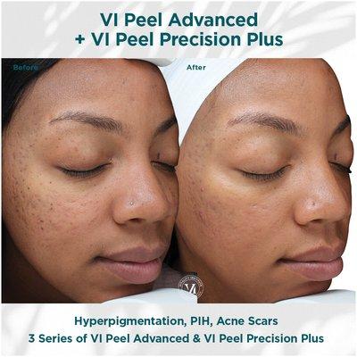 Vitality Institute chemical peel that shreds layers of epidermis skin to treat acne scars and hyperpigmentation.