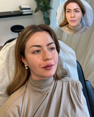 This client came in for facial balancing. We gave her a little chin filler, filled her smile lines, added some tox, and touched up her lips.