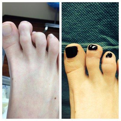 hammertoe deformity