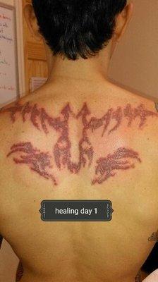 Alex L: healing day 1 post first laser removal session