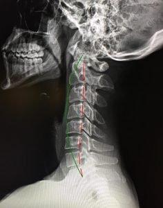 X-ray before