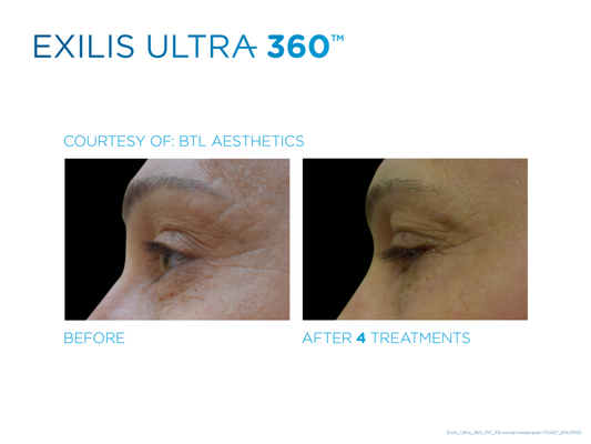 Non-invasive, No-down time Exilis Ultra radiofrequency -used for skin tightening