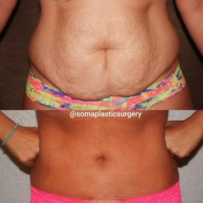 Tummy Tuck and Lipo for our mommy makeover.