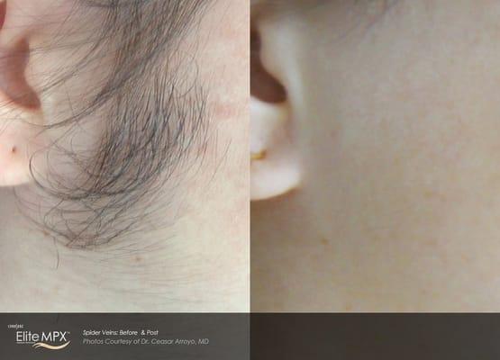 Before and After   Laser Hair Removal