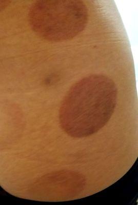 My right buttock from Dr. Song's Aggressive Cupping!