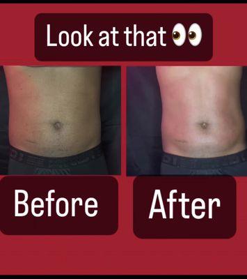 This is his second laser lipo cavitation and already seeing results!