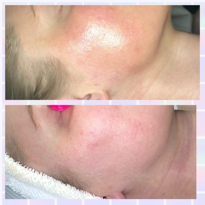 Dermaplaning 
Top photo is after 
Bottom is before