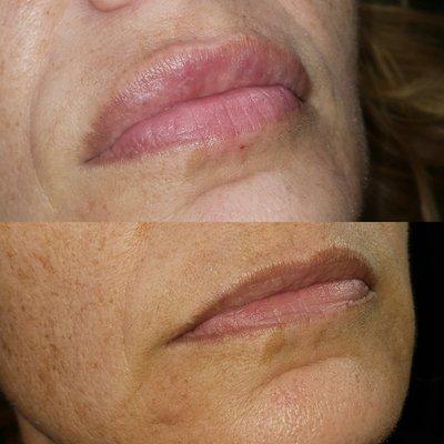 Needle-free lip enhancement.. say what?! Yes, its true