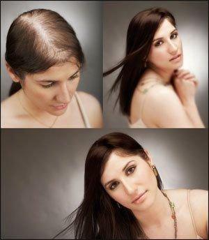 100% Human Hair Restoration - Non-surgical and integrates with your own hair