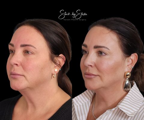 Full face rejuvenation with Botox and Juvederm Filler