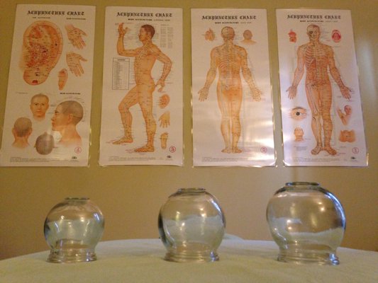 Acupuncture point charts and cups used in cupping therapy