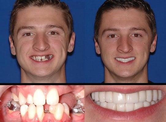 Dental Implants + All On Four + Teeth In a Day