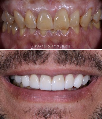 Veneers