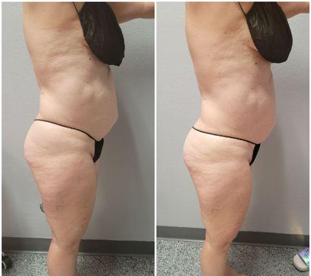 Before and After: 1st session of 360 Non-invasive Laser Lipo to full midsection.