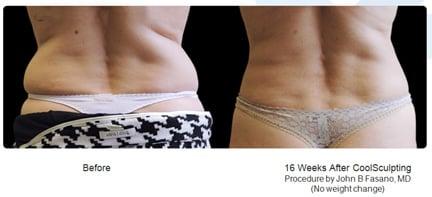 CoolSculpting Client