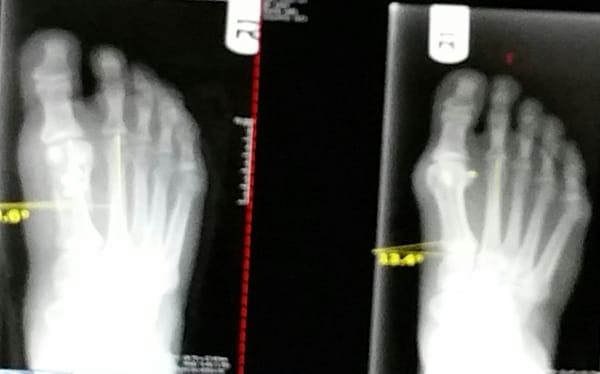 Before and after xray. On the right you can clearly see my bunion, on the left-bunion is gone!!!