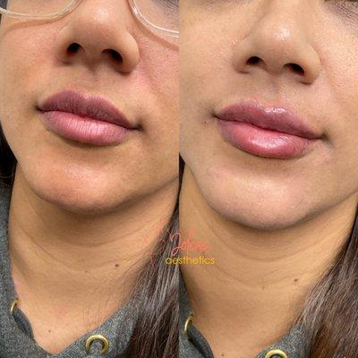 Already gorgeous lips but perfection for this first time lip filler patient.