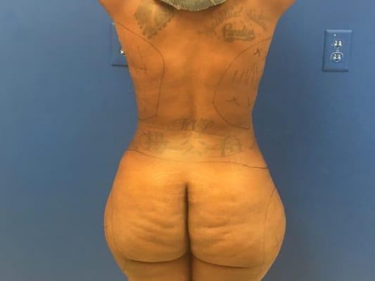 Liposuction/ Brazilian Butt lift before picture 6/25/16