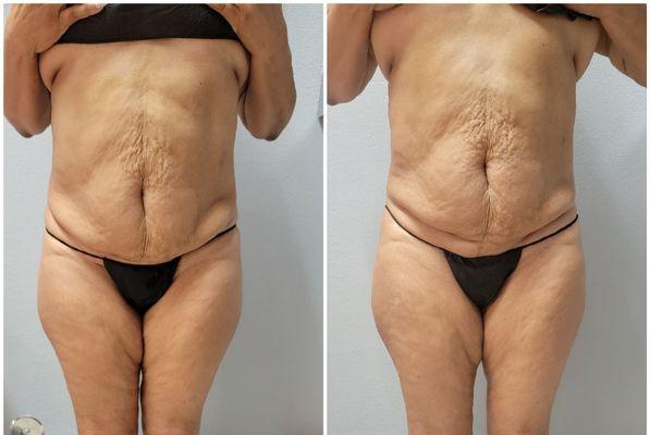 Before and After: Non-invasive Laser Lipo/ Skin Tightening to the upper and lower abdomen.