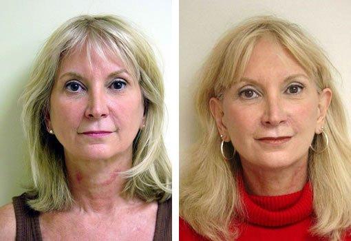 Facelift Surgery