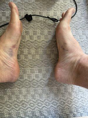 Bruising of feet after enzyme injections for Ledderhosen disease also known as Plantar Fibromatosis