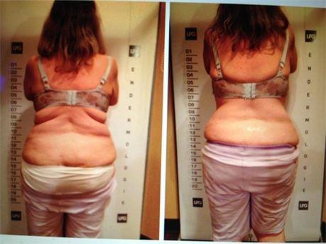 Let us Help you Get Rid of Rolls of Fat!