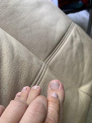 Toenail infection