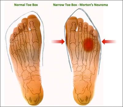 Why does Morton's neuroma occur?