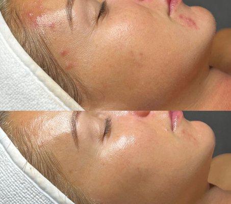 Our beautiful clients skin before and after 2 hydrofacials, and 6 weeks using The Jan Marini Starter Skin Care system.