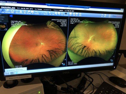 My eyes! The light dot is the optic nerve and the dark spot is the functioning macula. Vessels look good.