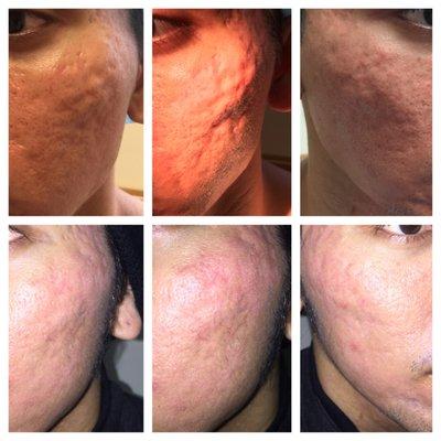 Rolling and atrophic Acne scarring