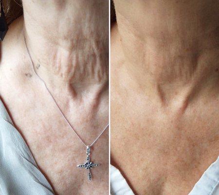 Skin tightening