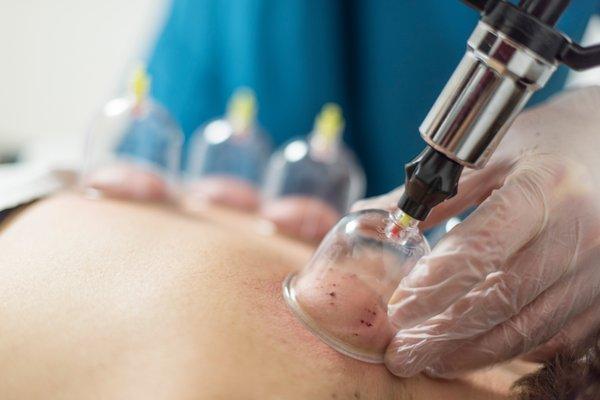 Cupping or myofascial decompression