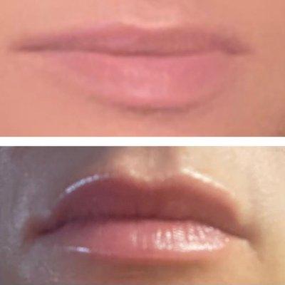 HydraFacial Perk Lip Treatment Before and After