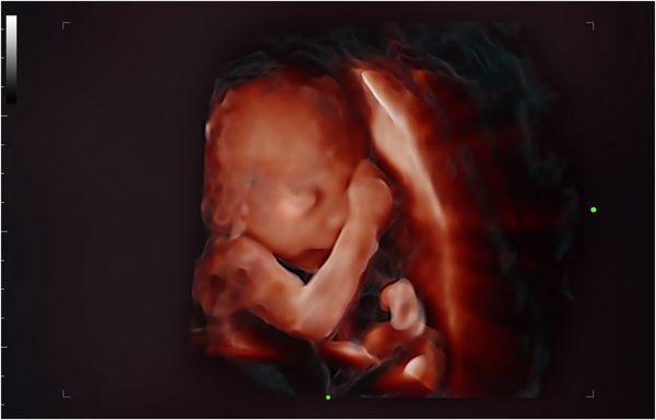 3D image of baby in utero