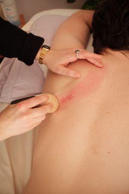 Gua Sha and cupping are available for in person treatments.