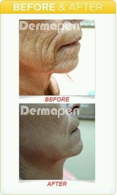 #Dermapen aka #magicearser.