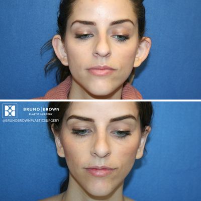 This patient had concerns regarding her prominent ears.  She had ear surgery, also known as otoplasty.