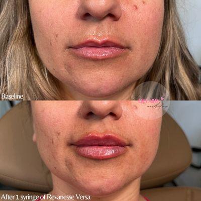 Before and after lip filler using Revanesse Versa.