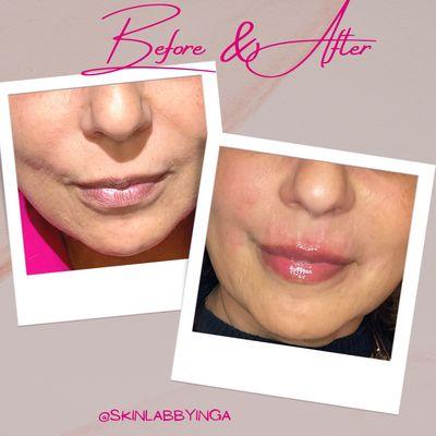 Added back
some subtle volume to her upper lip, smoothened out smokers and smile lines