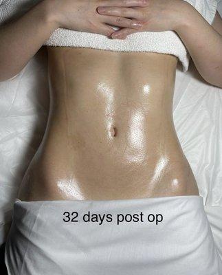 Lipo 360 by Dr Larry Fan - 32 days post op