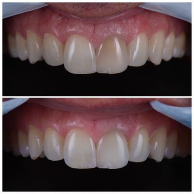 Internal bleaching done to single tooth to whiten dark tooth