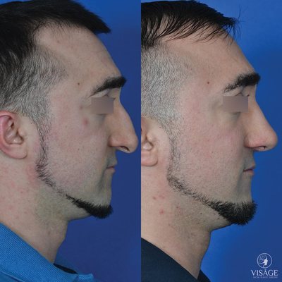 Before/after male rhinoplasty