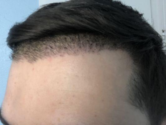 10 days after the procedure (1750 grafts)